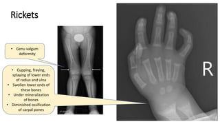 Rickets
• Cupping, fraying,
splaying of lower ends
of radius and ulna
• Swollen lower ends of
these bones
• Under mineralization
of bones
• Diminished ossification
of carpal pones
• Genu valgum
deformity
 