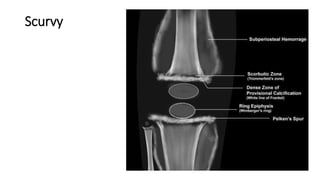 Scurvy
 