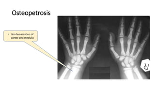 Osteopetrosis
• No demarcation of
cortex and medulla
 