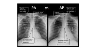 Clavicle at or
above apex
of lung fields
Clavicle
Within the
lung fields
Ribs - horizontalRibs - oblique
Scapula –
within the
lung fields
Scapula - away
from the lung
fields
Vertebral column -
Less distinct and
less dense
Vertebral column -
Distinctly seen
 