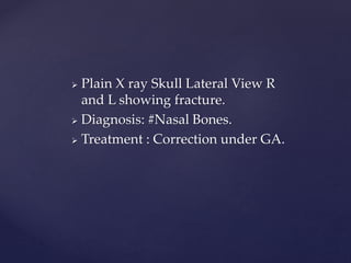  Plain X ray Skull Lateral View R
and L showing fracture.
 Diagnosis: #Nasal Bones.
 Treatment : Correction under GA.
 