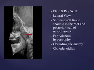  Plain X Ray Skull
 Lateral View
 Showing soft tissue
shadow in the roof and
posterior wall of
nasopharynx.
 For Adenoid
hypertrophy
 Occluding the airway
 Ch. Adenoiditis
 