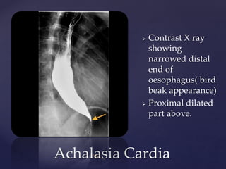Achalasia Cardia
 Contrast X ray
showing
narrowed distal
end of
oesophagus( bird
beak appearance)
 Proximal dilated
part above.
 