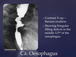 Ca. Oesophagus
 Contrast X ray –
Barium swallow.
 Showing Irregular
filling defects in the
middle 1/3rd of the
oesophagus.
 