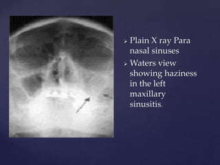  Plain X ray Para
nasal sinuses
 Waters view
showing haziness
in the left
maxillary
sinusitis.
 