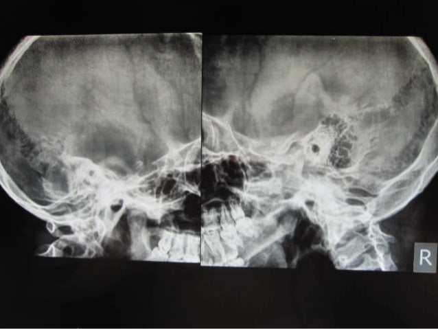 Xrays In Ent Dr Ashly Alexander Xrays In Ent Dr Ashly Alexander