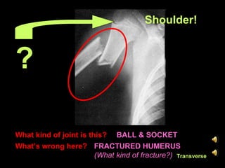What kind of joint is this?
FRACTURED HUMERUS
(What kind of fracture?)
What’s wrong here?
BALL & SOCKET
?
Shoulder!
Transverse
 