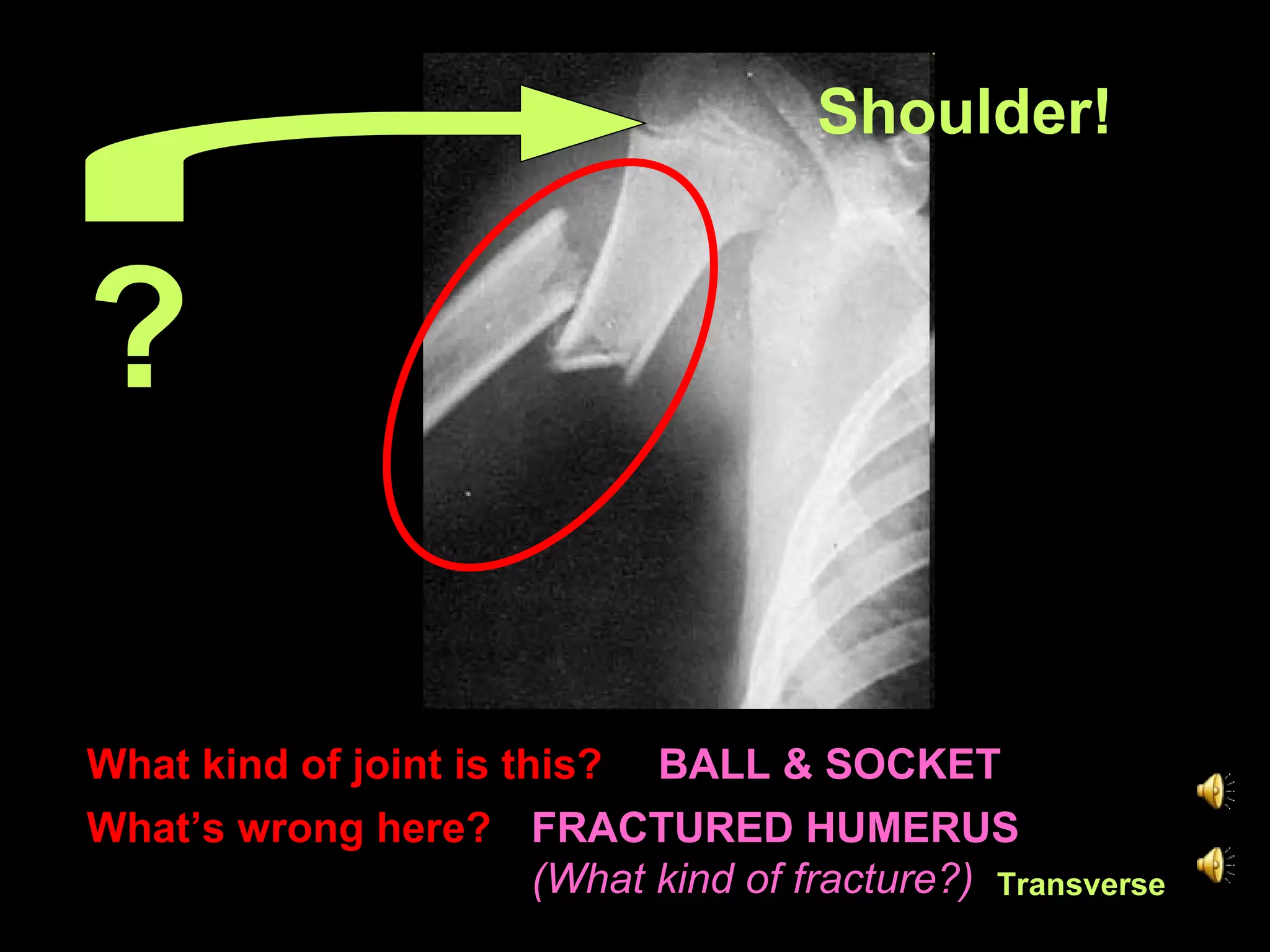 What kind of joint is this?  FRACTURED HUMERUS  (What kind of fracture?) What’s wrong here?   BALL & SOCKET ? Shoulder! Transverse 
