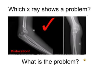 Which x ray shows a problem? What is the problem? Dislocation!  