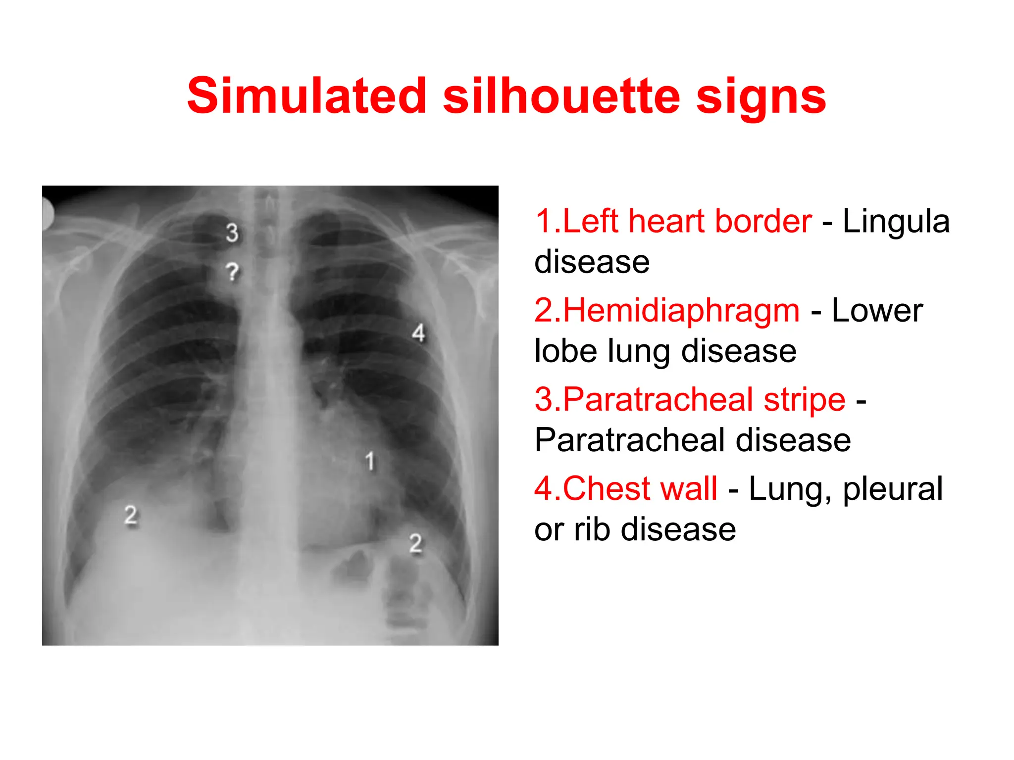 Simulated silhouette signs
1.Left heart border - Lingula
disease
2.Hemidiaphragm - Lower
lobe lung disease
3.Paratracheal stripe -
Paratracheal disease
4.Chest wall - Lung, pleural
or rib disease
 