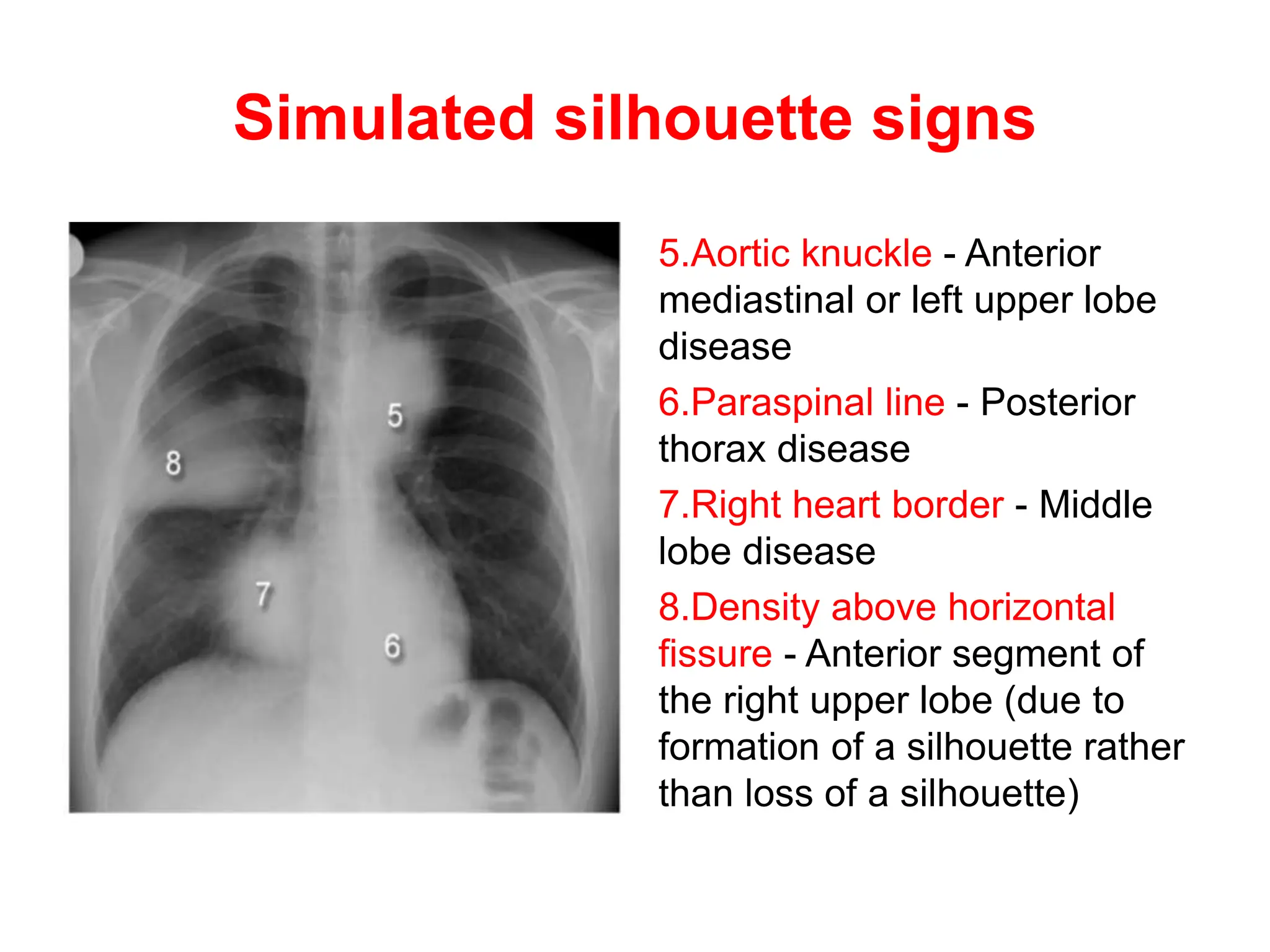 Simulated silhouette signs
5.Aortic knuckle - Anterior
mediastinal or left upper lobe
disease
6.Paraspinal line - Posterior
thorax disease
7.Right heart border - Middle
lobe disease
8.Density above horizontal
fissure - Anterior segment of
the right upper lobe (due to
formation of a silhouette rather
than loss of a silhouette)
 