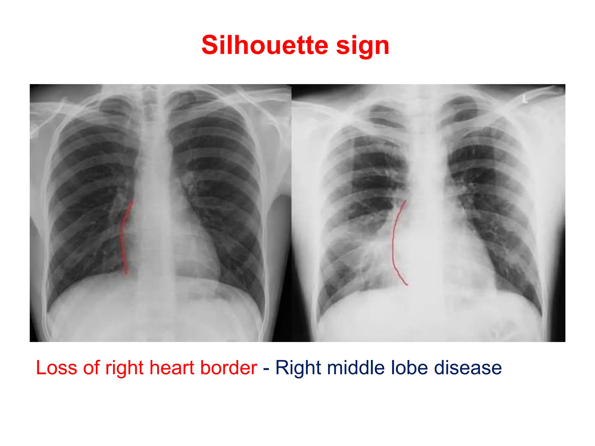 Silhouette sign
Loss of right heart border - Right middle lobe disease
 