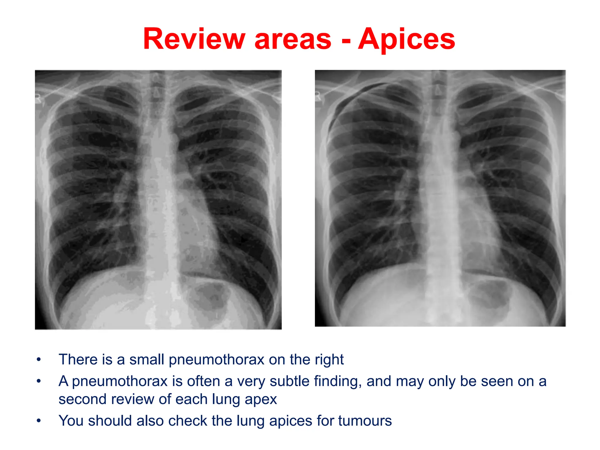 Review areas - Apices
• There is a small pneumothorax on the right
• A pneumothorax is often a very subtle finding, and may only be seen on a
second review of each lung apex
• You should also check the lung apices for tumours
 