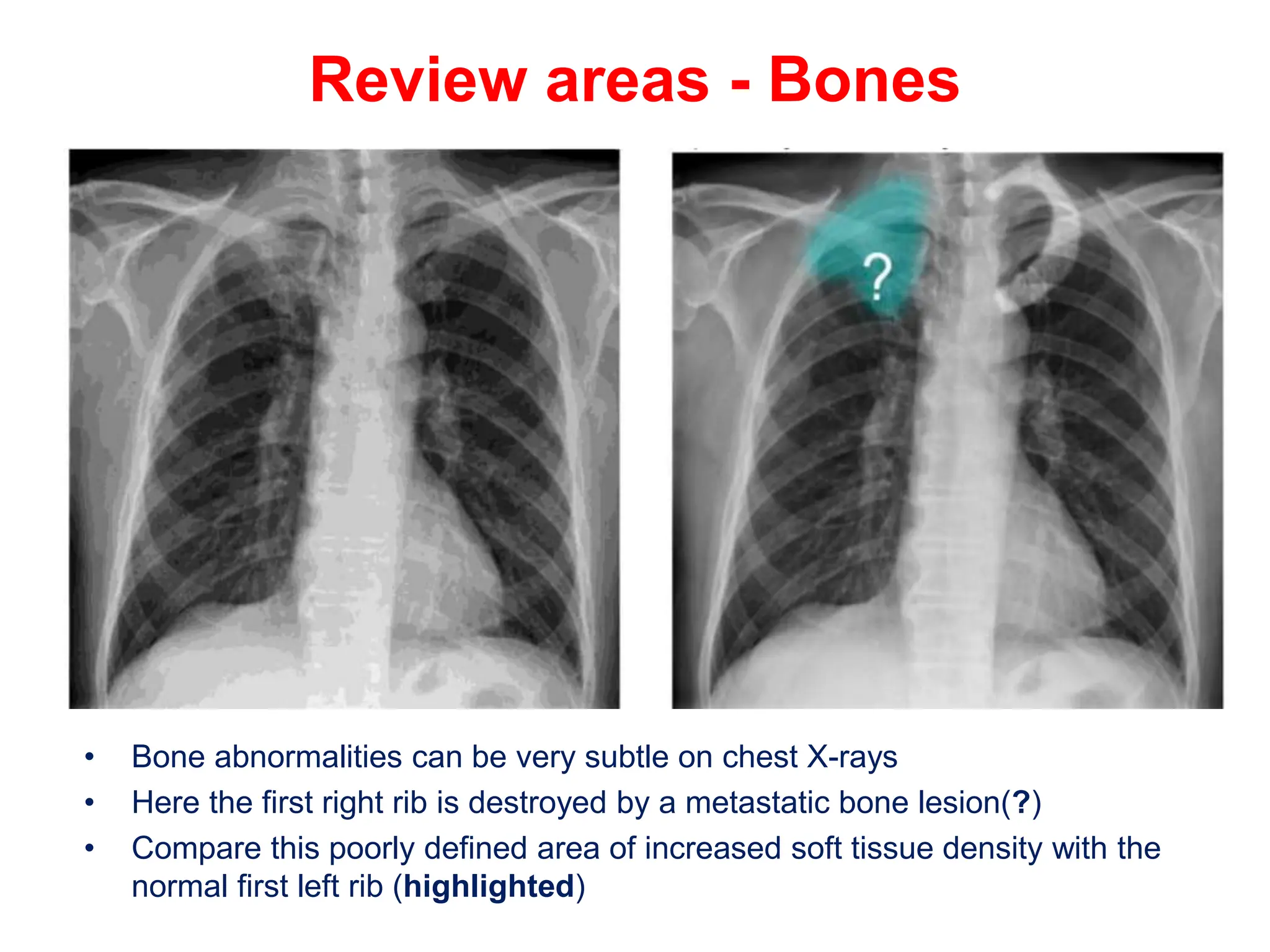 Review areas - Bones
• Bone abnormalities can be very subtle on chest X-rays
• Here the first right rib is destroyed by a metastatic bone lesion(?)
• Compare this poorly defined area of increased soft tissue density with the
normal first left rib (highlighted)
 
