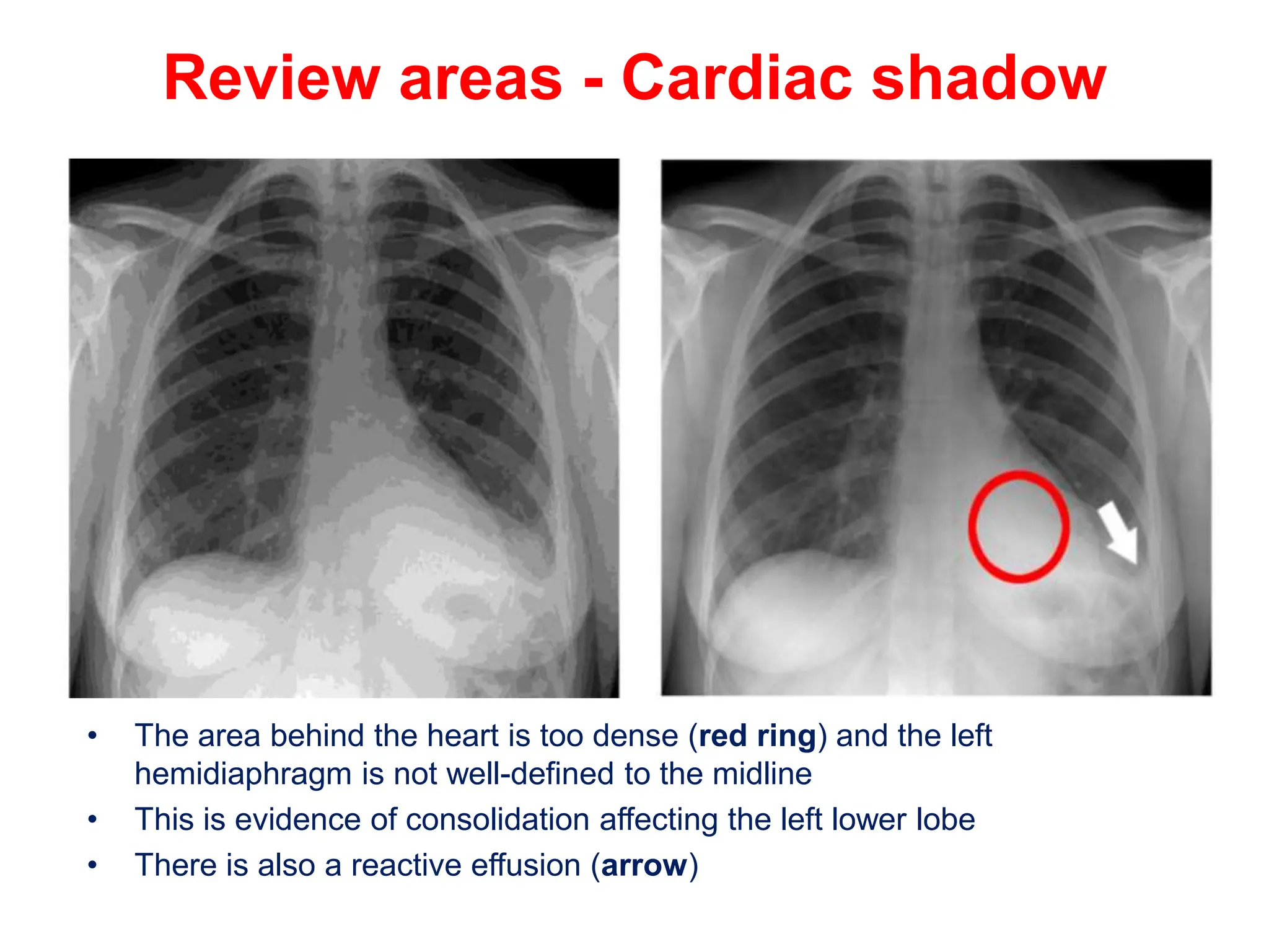 Review areas - Cardiac shadow
• The area behind the heart is too dense (red ring) and the left
hemidiaphragm is not well-defined to the midline
• This is evidence of consolidation affecting the left lower lobe
• There is also a reactive effusion (arrow)
 