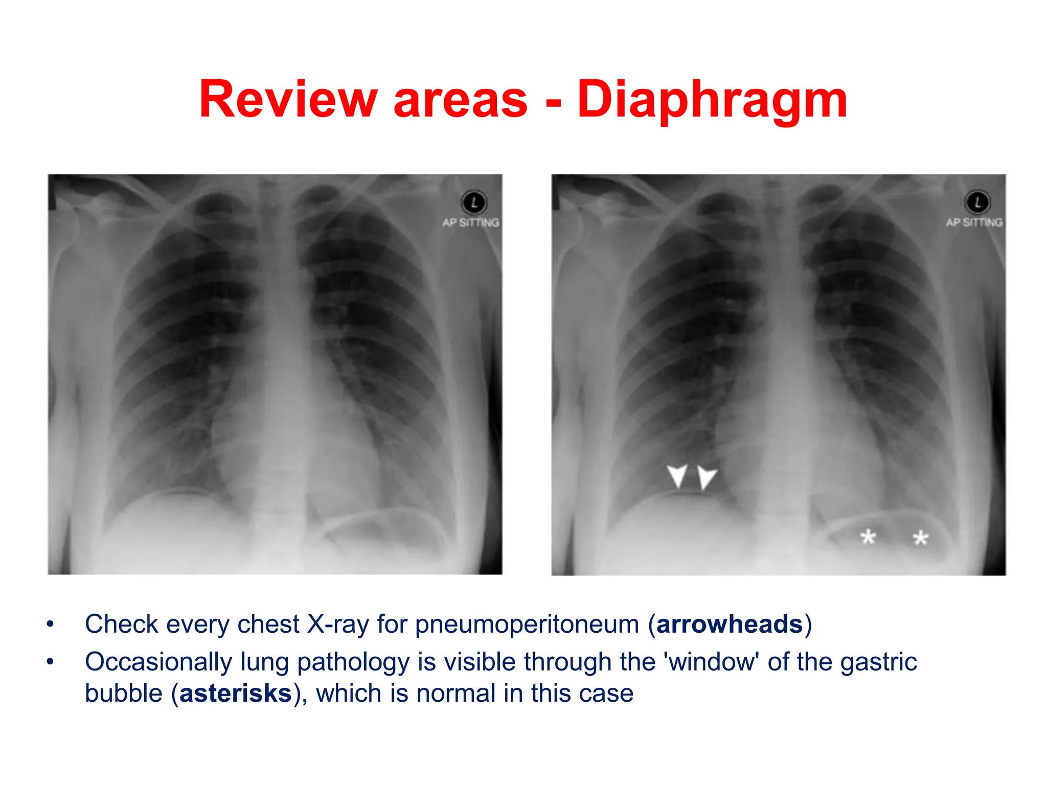 Review areas - Diaphragm
• Check every chest X-ray for pneumoperitoneum (arrowheads)
• Occasionally lung pathology is visible through the 'window' of the gastric
bubble (asterisks), which is normal in this case
 