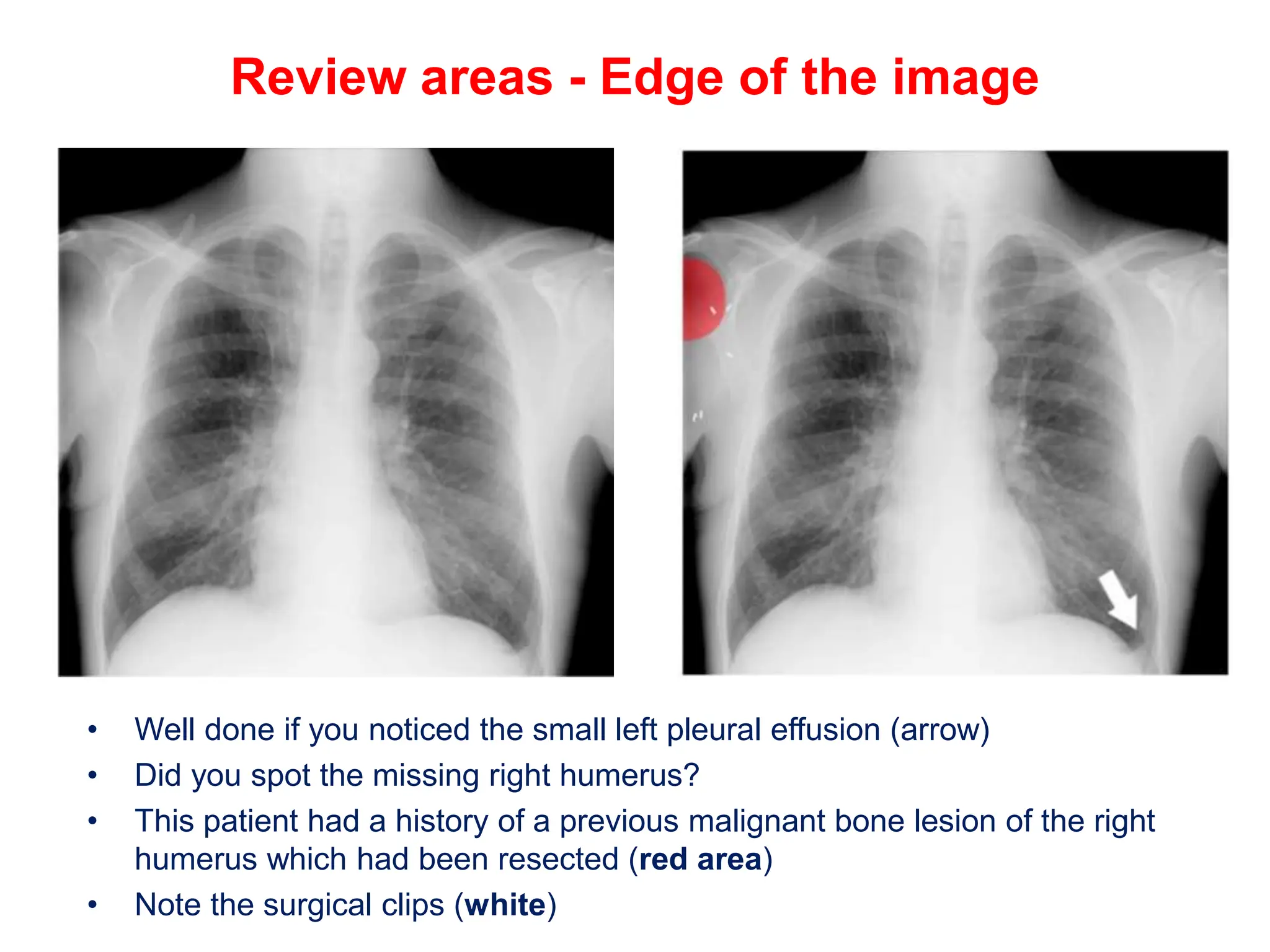 Review areas - Edge of the image
• Well done if you noticed the small left pleural effusion (arrow)
• Did you spot the missing right humerus?
• This patient had a history of a previous malignant bone lesion of the right
humerus which had been resected (red area)
• Note the surgical clips (white)
 
