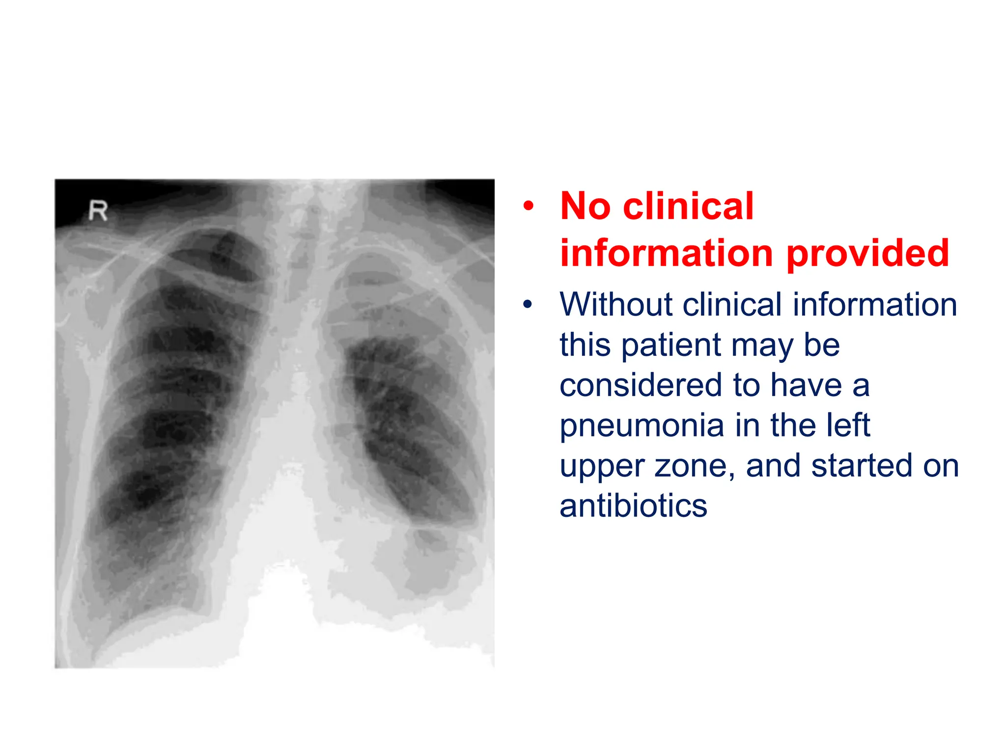 • No clinical
information provided
• Without clinical information
this patient may be
considered to have a
pneumonia in the left
upper zone, and started on
antibiotics
 