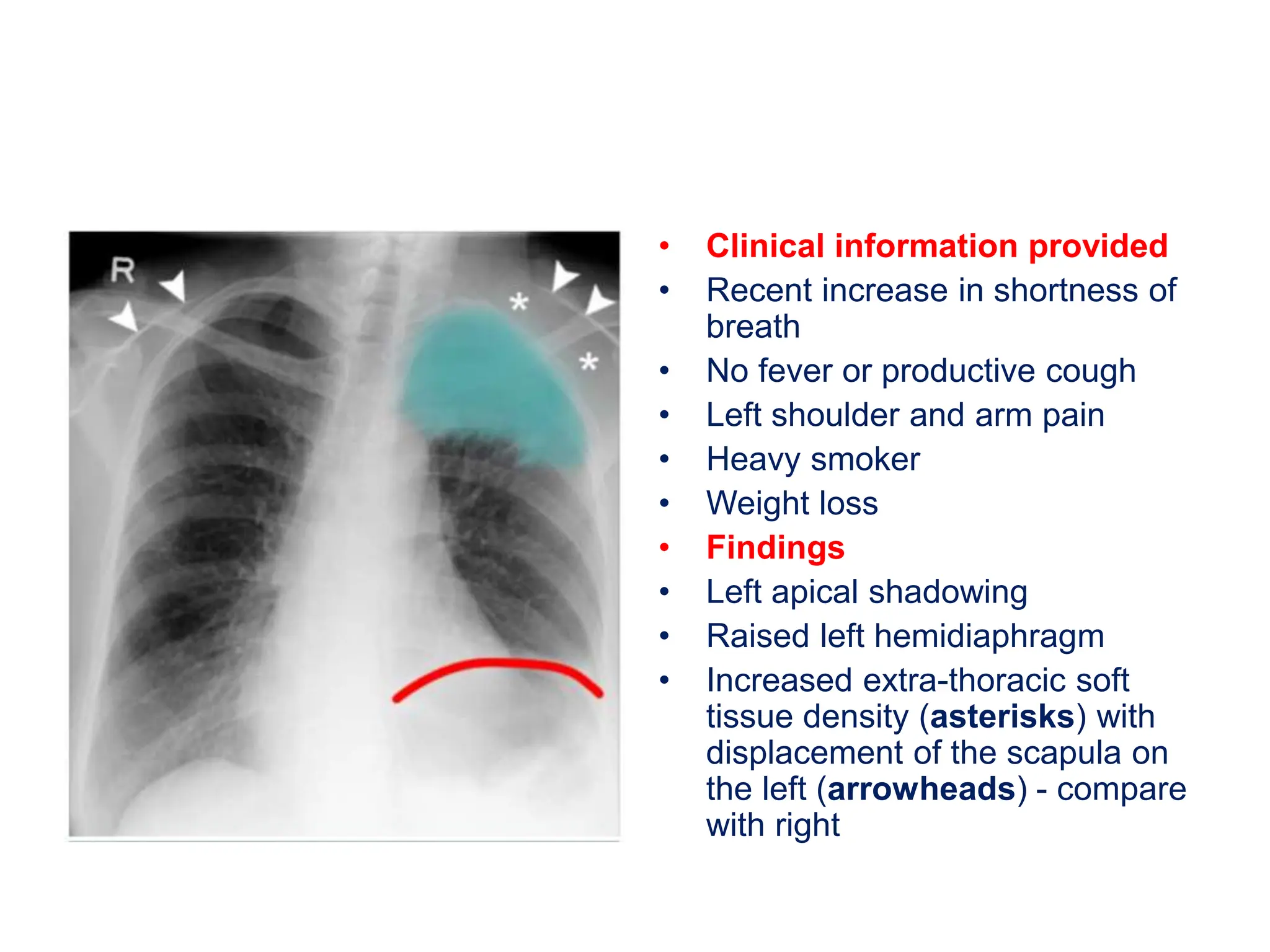 • Clinical information provided
• Recent increase in shortness of
breath
• No fever or productive cough
• Left shoulder and arm pain
• Heavy smoker
• Weight loss
• Findings
• Left apical shadowing
• Raised left hemidiaphragm
• Increased extra-thoracic soft
tissue density (asterisks) with
displacement of the scapula on
the left (arrowheads) - compare
with right
 