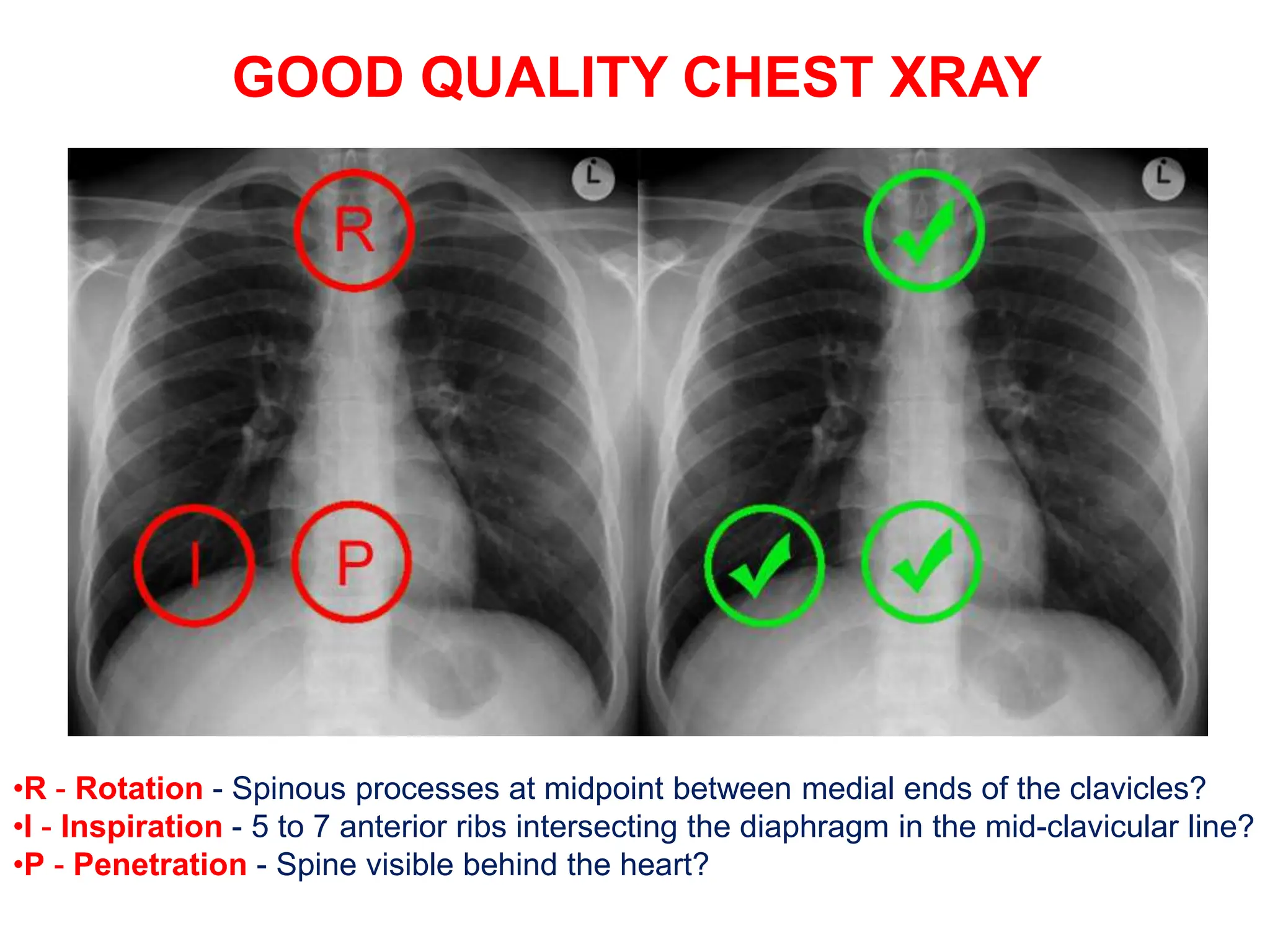 GOOD QUALITY CHEST XRAY
•R - Rotation - Spinous processes at midpoint between medial ends of the clavicles?
•I - Inspiration - 5 to 7 anterior ribs intersecting the diaphragm in the mid-clavicular line?
•P - Penetration - Spine visible behind the heart?
 