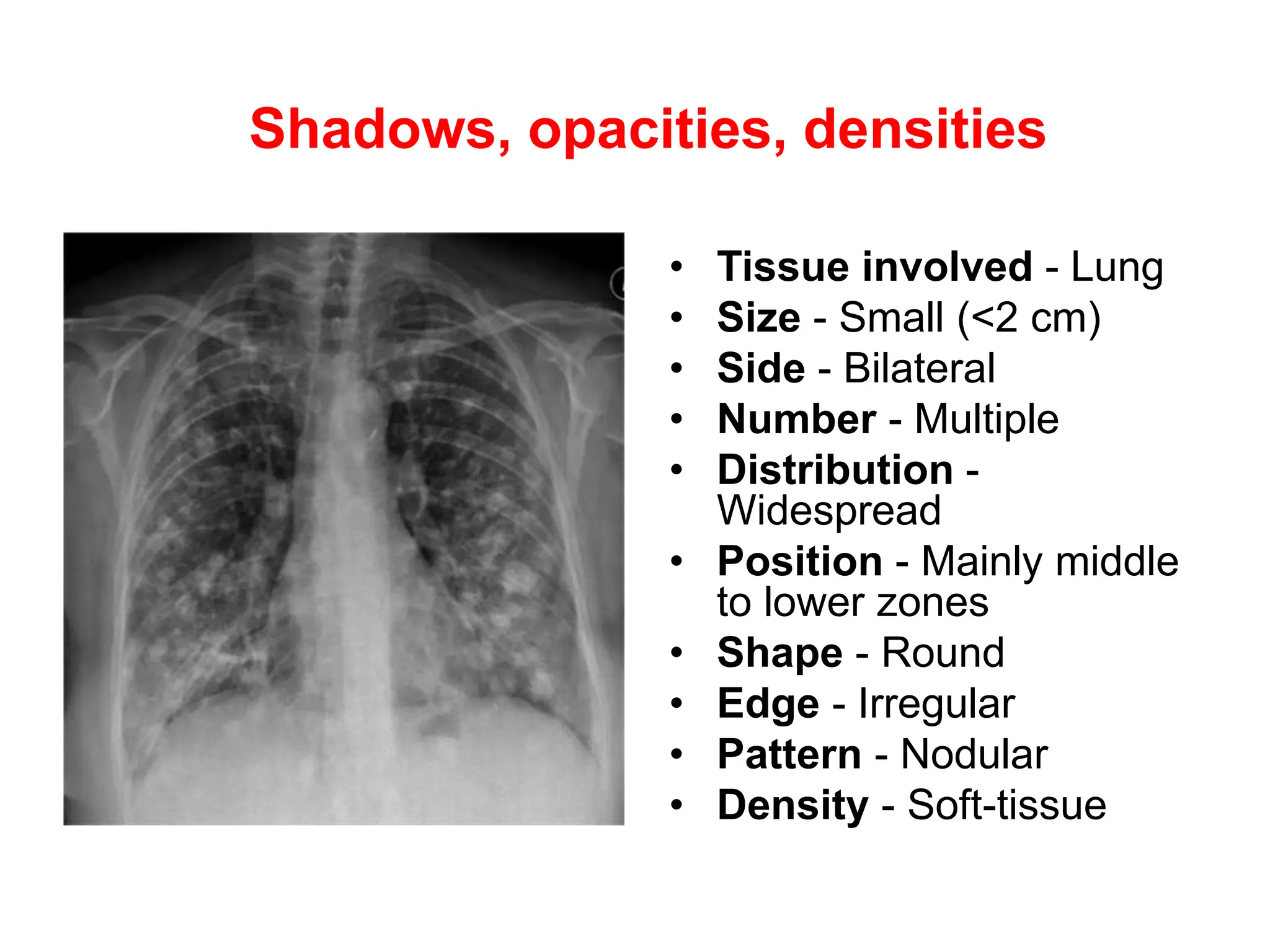 Shadows, opacities, densities
• Tissue involved - Lung
• Size - Small (<2 cm)
• Side - Bilateral
• Number - Multiple
• Distribution -
Widespread
• Position - Mainly middle
to lower zones
• Shape - Round
• Edge - Irregular
• Pattern - Nodular
• Density - Soft-tissue
 