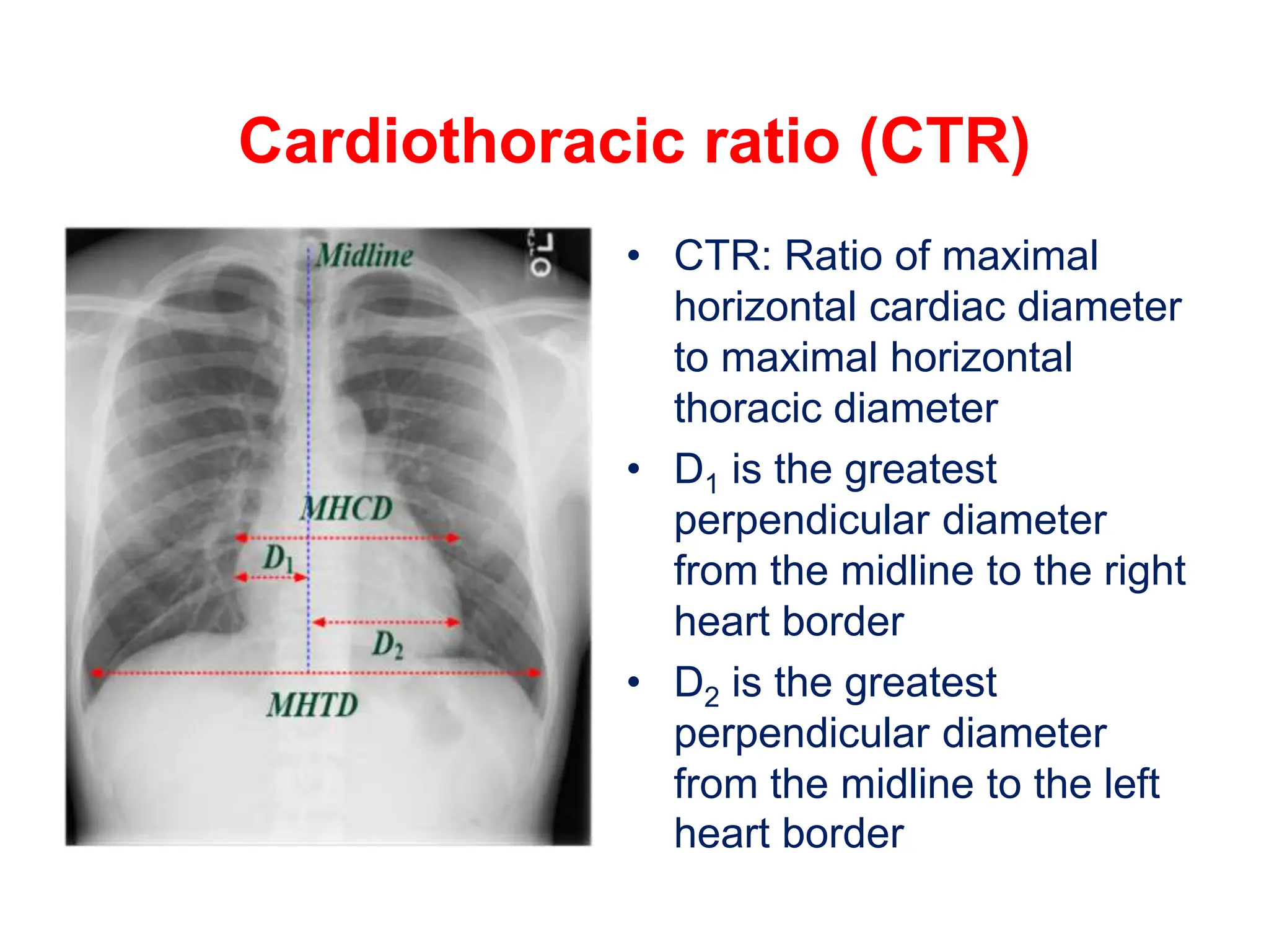 CHEST XRAYS STEP BY STEP APPROACH pptx CHEST XRAYS STEP BY STEP APPROACH pptx