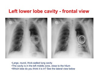 CHEST XRAYS STEP BY STEP APPROACH,,.pptx