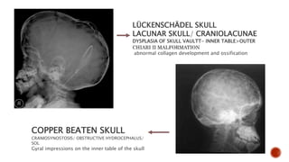 LÜCKENSCHÄDEL SKULL
LACUNAR SKULL/ CRANIOLACUNAE
DYSPLASIA OF SKULL VAULTT- INNER TABLE>OUTER
CHIARI II MALFORMATION
abnormal collagen development and ossification
COPPER BEATEN SKULL
CRANIOSYNOSTOSIS/ OBSTRUCTIVE HYDROCEPHALUS/
SOL
Gyral impressions on the inner table of the skull
 