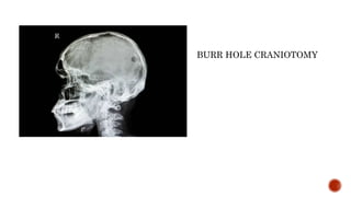 BURR HOLE CRANIOTOMY
 