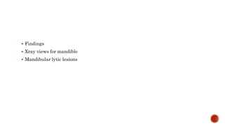  Findings
 Xray views for mandible
 Mandibular lytic lesions
 