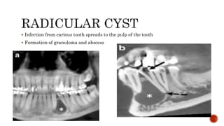  Infection from carious tooth spreads to the pulp of the tooth
 Formation of granuloma and abscess
 