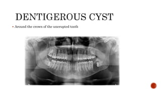  Around the crown of the unerupted tooth
 