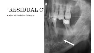  After extraction of the tooth
 