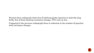 Frontal chest radiograph shows few ill defined patchy opacities in both the lung
fields, few of them showing cavitatory changes. TCC seen in situ.
Compared to the previous radiograph there is reduction in the number of opacities
with cavitatory changes.
 