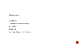  Distribution :
 Peripheral
 Lower lobe predominance
 Multiple
 Bilateral
 Varying stages of cavitation
 