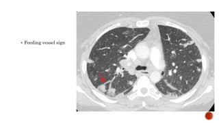  Feeding vessel sign
 