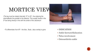  INDICATION
 Ankle farcture/dislocation
 Talus involvement
 Osteoarthritis ankle
•The leg must be rotated internally 15° to 20°, thus aligning the
intermalleolar line parallel to the detector. This usually results in the
5th toe being directly in line with the center of the calcaneum
•To differentiate from AP – the tibia , fibula , talus overlap is gone
 