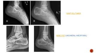 GIANT CELL TUMOR
BONE CYST (UNICAMERAL/ ANEURYSMAL)
 