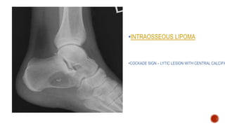 •INTRAOSSEOUS LIPOMA
•COCKADE SIGN – LYTIC LESION WITH CENTRAL CALCIFIC
 