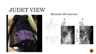Rotated 450 anterior
 