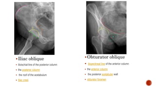 Iliac oblique
 ilioischial line of the posterior column
 the posterior column
 the roof of the acetabulum
 Iliac crest.
Obturator oblique
 iliopectineal line of the anterior column
 the anterior column
 the posterior acetabular wall
 obturator foramen
 