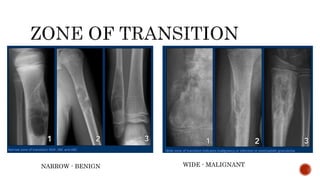NARROW - BENIGN WIDE - MALIGNANT
 
