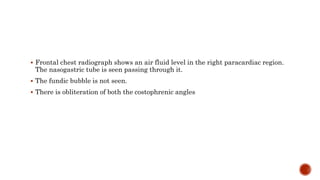  Frontal chest radiograph shows an air fluid level in the right paracardiac region.
The nasogastric tube is seen passing through it.
 The fundic bubble is not seen.
 There is obliteration of both the costophrenic angles
 