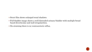  Scout film shows enlarged renal shadows
 Full bladder image shows a well distended urinary bladder with multiple broad
based diverticulae and wall irregularities.
 On straining there is no vesicoureteric reflux.
 