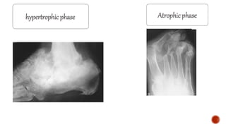Atrophic phase
hypertrophic phase
 