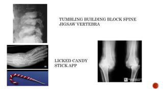 TUMBLING BUILDING BLOCK SPINE
JIGSAW VERTEBRA
LICKED CANDY
STICK APP
 