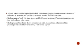  AP and lateral radiographs of the skull show multiple tiny lucent areas with areas of
sclerosis in between, giving rise to salt and pepper skull appearance.
 Radiographs of both the legs, knees and left humerus show diffuse osteoporosis with
few well defined lytic areas.
 Radiograph of the hand shows osteoporosis with coarse trabeculations of the
phalanges with mild erosions along tteh radial aspect.
 