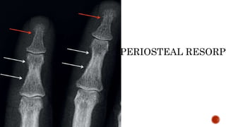 SUBPERIOSTEAL RESORPT
 