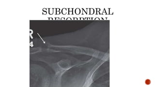 SUBCHONDRAL
RESORPTION
 
