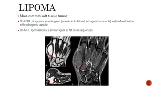  Most common soft tissue tumor
 On USG , it appears as echogenic (isoechoic to fat and echogenic to muscle) well-defined lesion
with echogenic capsule
 On MRI, lipoma shows a similar signal to fat on all sequences
 